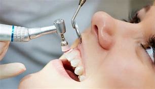Jenis Perawatan Gigi Yang Ditanggung Asuransi